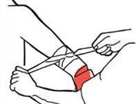 CÁC BƯỚC CẦM MÁU TẠM THỜI