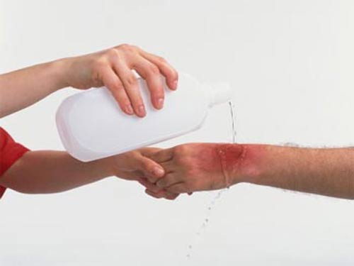 CÁC BƯỚC SƠ CỨU  KHI BỊ BỎNG